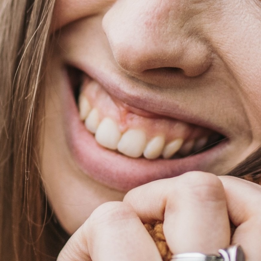 Gummy Smile